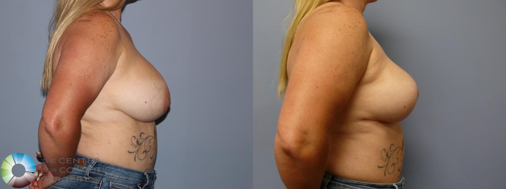 Before & After Breast Implant Removal (Explant) Case 11923 Right Side in Denver and Colorado Springs, CO