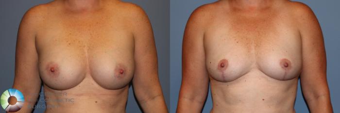 Before & After Breast Lift Case 11956 Front in Denver and Colorado Springs, CO