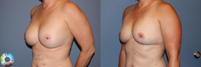 Before & After Breast Lift Case 11956 Left Oblique in Denver and Colorado Springs, CO