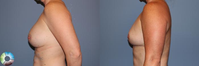 Before & After Breast Lift without Implants Case 11956 Left Side in Denver and Colorado Springs, CO