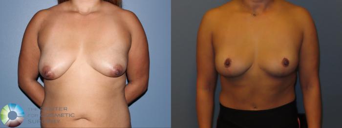 Before & After Breast Implant Removal (Explant) Case 12015 Front in Denver and Colorado Springs, CO