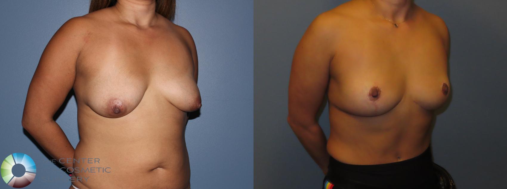 Before & After Breast Implant Removal (Explant) Case 12015 Right Oblique in Denver and Colorado Springs, CO