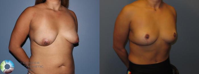 Before & After Breast Implant Removal (Explant) Case 12015 Right Oblique in Denver and Colorado Springs, CO