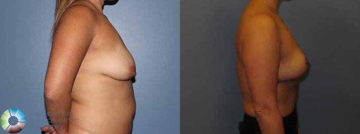 Before & After Breast Implant Removal (Explant) Case 12015 Right Side in Denver and Colorado Springs, CO