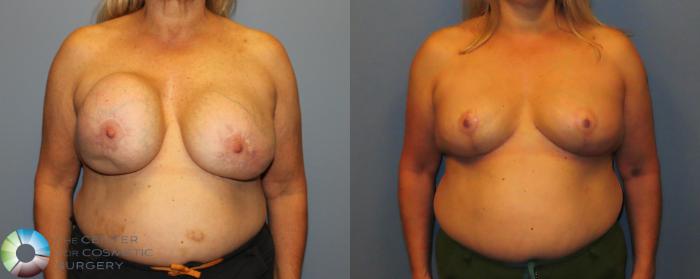 Before & After Breast Implant Removal (Explant) Case 12157 Front in Denver and Colorado Springs, CO
