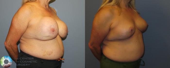Before & After Breast Implant Removal (Explant) Case 12157 Right Oblique in Denver and Colorado Springs, CO