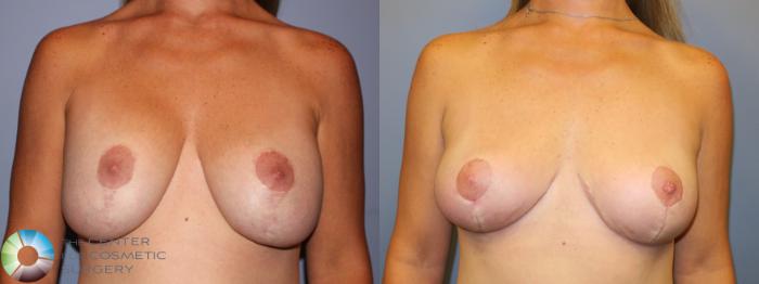 Before & After Breast Implant Revision Case 11255 Front View in Golden, CO