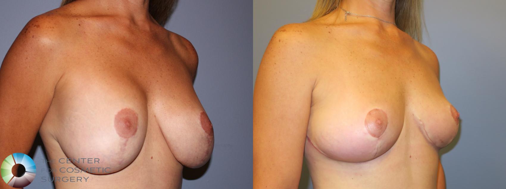 Denver Breast Implant Removal/Revision