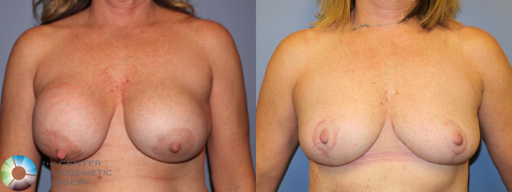 Denver Breast Implant Removal/Revision