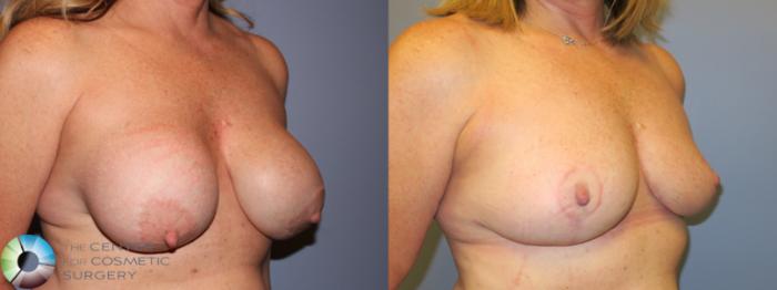 Before & After Breast Implant Revision Case 11256 Right Oblique View in Golden, CO