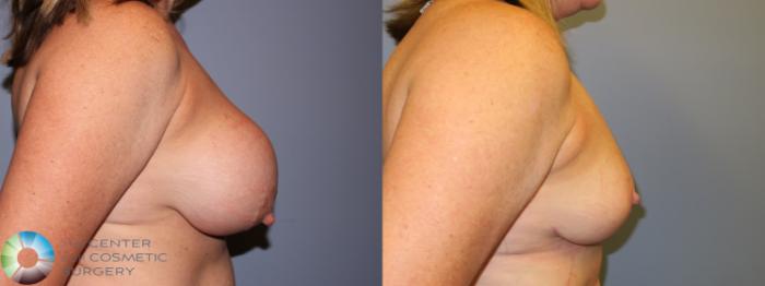 Before & After Breast Implant Revision Case 11256 Right Side View in Golden, CO