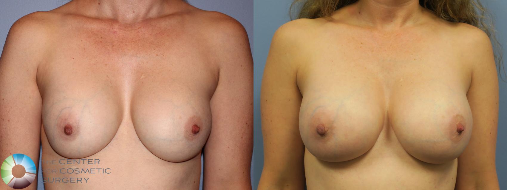 Before & After Breast Implant Revision Case 11257 Front in Denver and Colorado Springs, CO