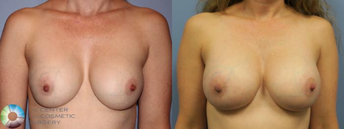 Before & After Breast Implant Revision Case 11257 Front View in Golden, CO