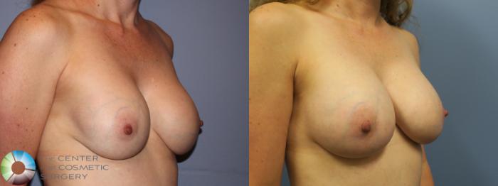 Before & After Breast Implant Revision Case 11257 Right Oblique View in Golden, CO
