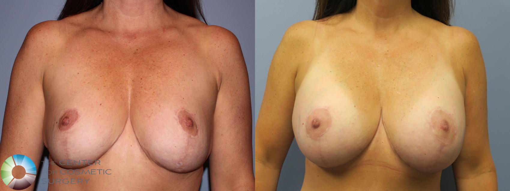 Before & After Breast Implant Revision Case 11267 Front View in Golden, CO