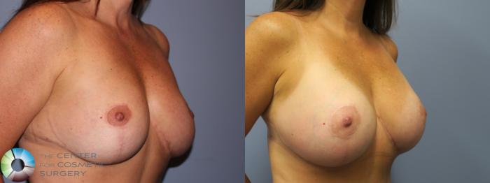 Before & After Breast Implant Revision Case 11267 Right Oblique View in Golden, CO