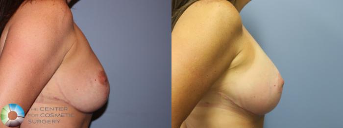 Before & After Breast Implant Revision Case 11267 Right Side View in Golden, CO
