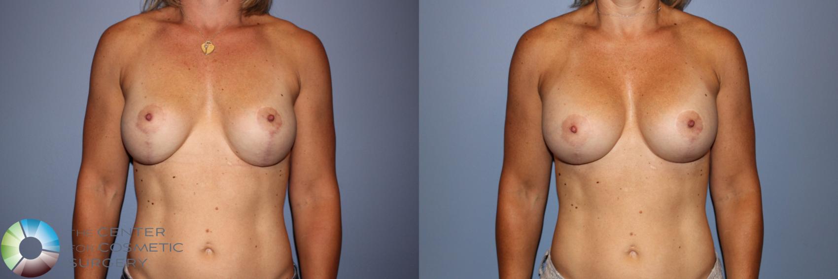 Before & After Breast Implant Revision Case 11295 Front View in Golden, CO
