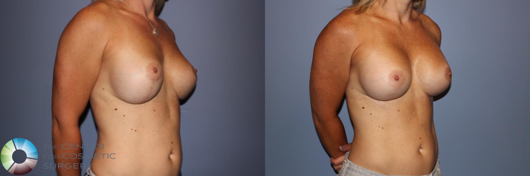 Before & After Breast Implant Revision Case 11295 Right Oblique View in Golden, CO