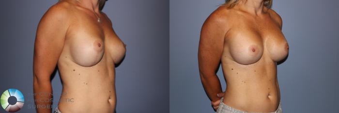 Before & After Breast Implant Revision Case 11295 Right Oblique in Denver and Colorado Springs, CO