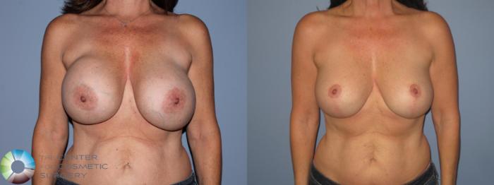 Before & After Breast Implant Revision Case 11303 Front View in Golden, CO