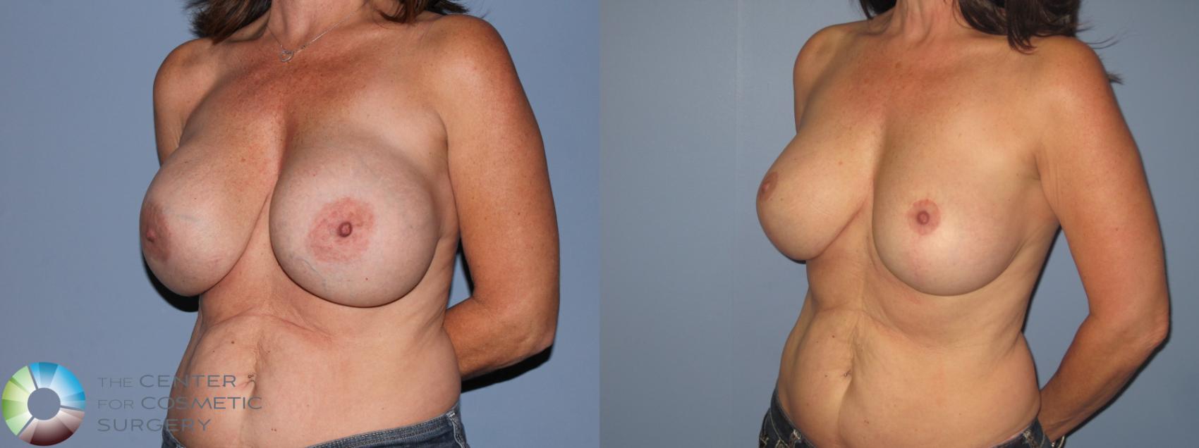 Before & After Breast Implant Revision Case 11303 Left Oblique View in Golden, CO