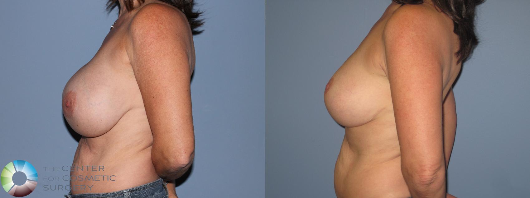 Before & After Breast Implant Revision Case 11303 Left Side View in Golden, CO