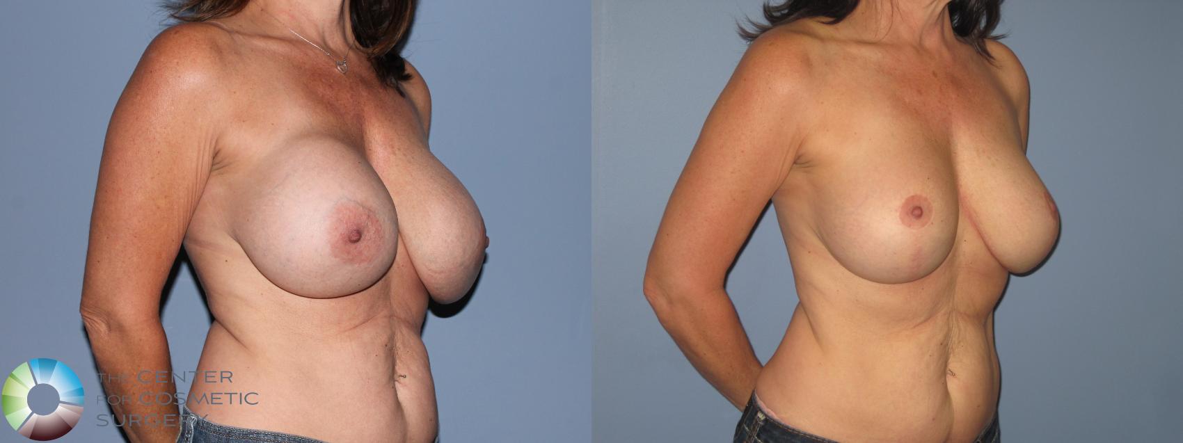 Before & After Breast Implant Revision Case 11303 Right Oblique View in Golden, CO
