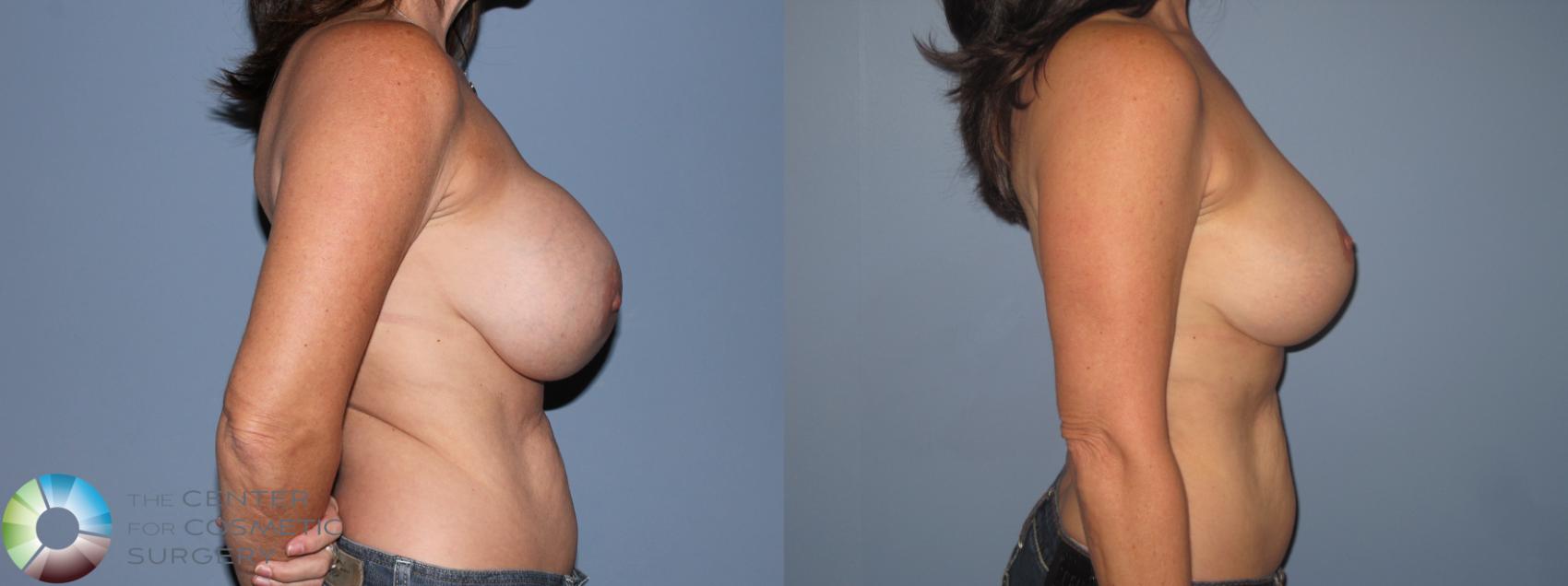 Before & After Breast Implant Revision Case 11303 Right Side View in Golden, CO