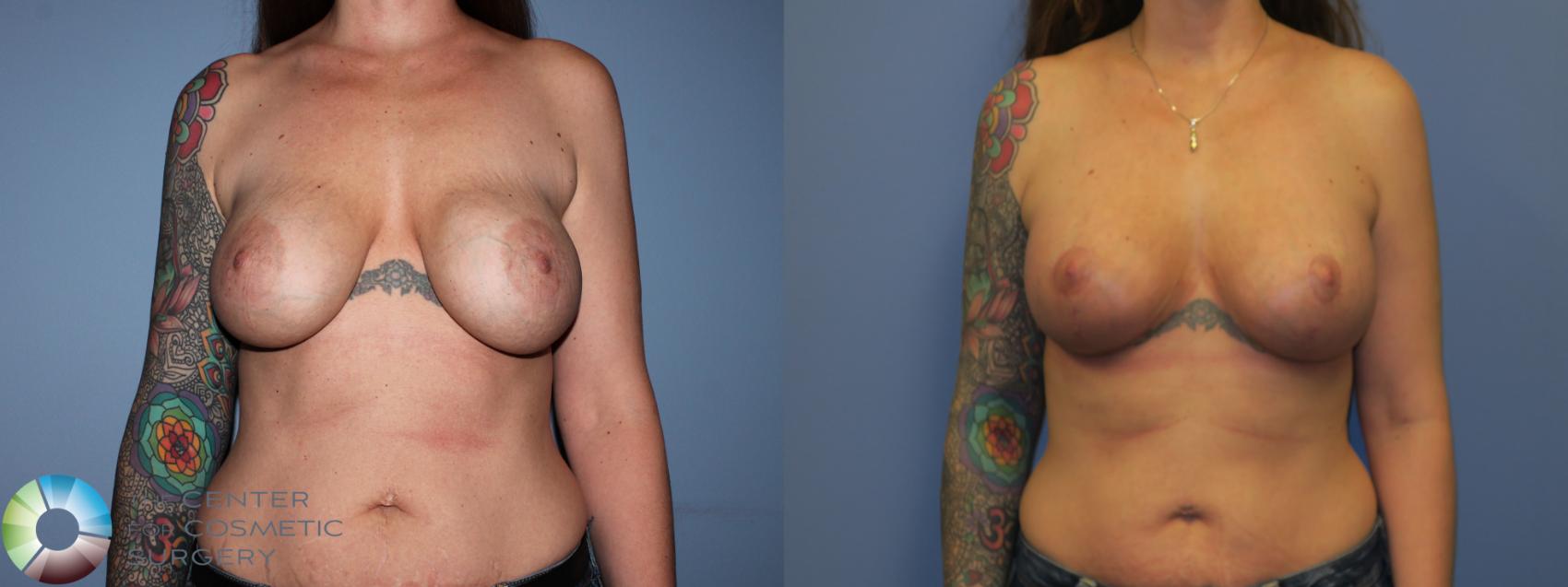 Before & After Breast Implant Revision Case 11304 Front View in Golden, CO