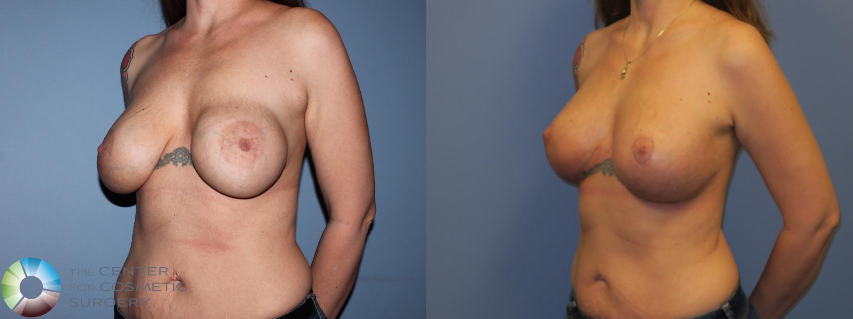 Before & After Breast Implant Revision Case 11304 Left Oblique View in Golden, CO