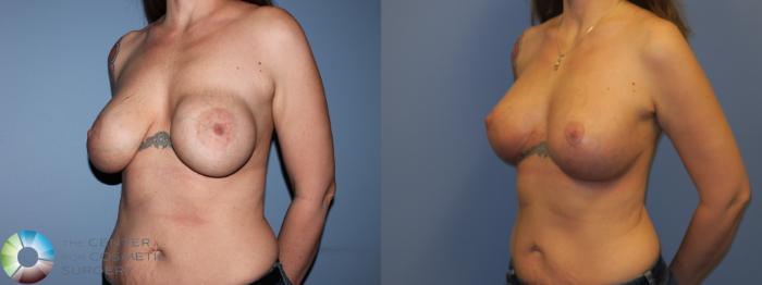 Before & After Breast Lift Case 11304 Left Oblique View in Golden, CO
