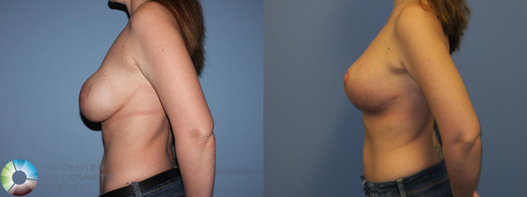Before & After Breast Implant Revision Case 11304 Left Side View in Golden, CO