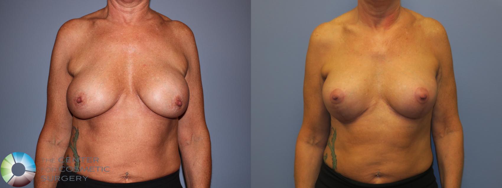 Before & After Breast Implant Revision Case 11305 Front in Denver and Colorado Springs, CO