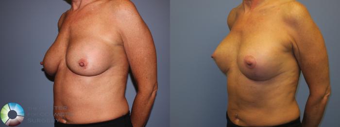 Before & After Breast Implant Revision Case 11305 Left Oblique in Denver and Colorado Springs, CO