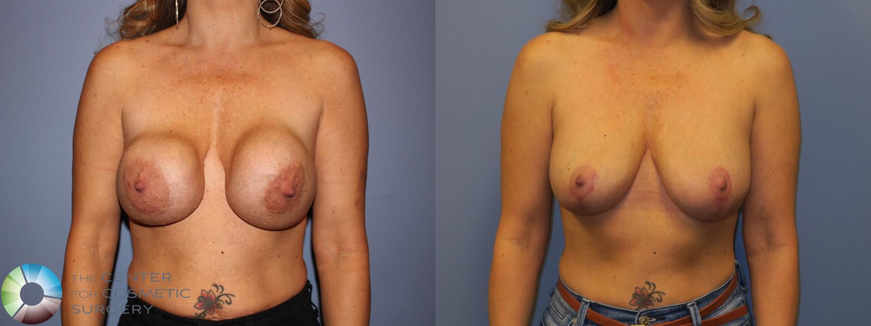 Before & After Breast Implant Revision Case 11306 Front in Denver and Colorado Springs, CO