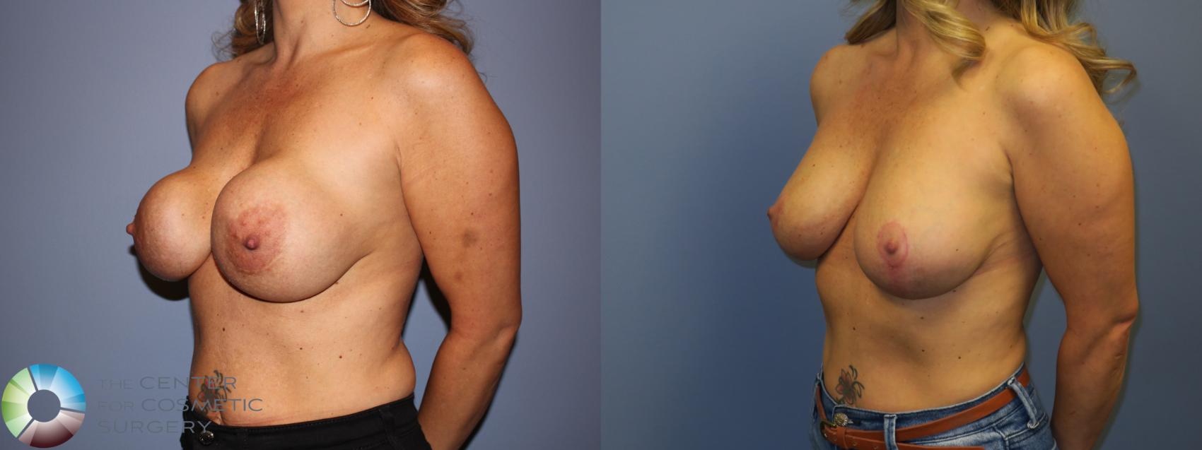 Before & After Breast Implant Revision Case 11306 Left Oblique in Denver and Colorado Springs, CO
