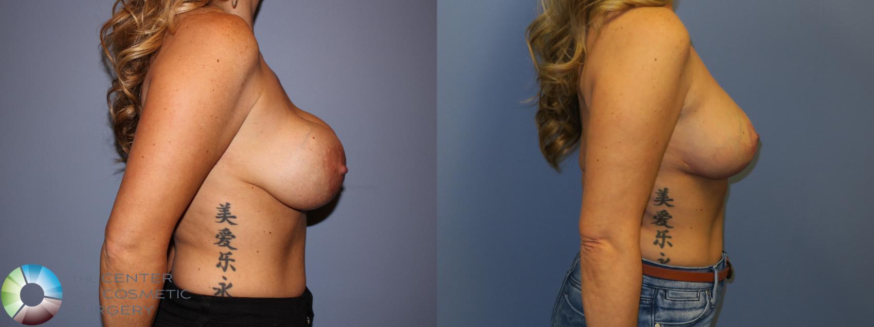 Before & After Breast Implant Revision Case 11306 Right Side in Denver and Colorado Springs, CO