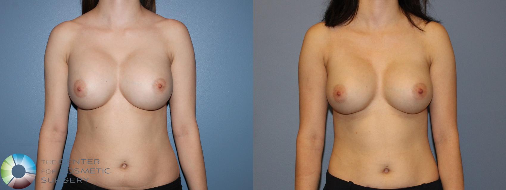 Before & After Breast Implant Revision Case 11320 Front View in Golden, CO