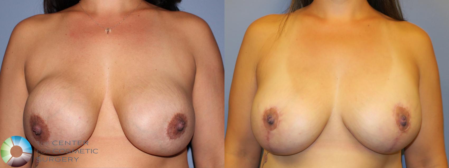 Before & After Breast Implant Revision Case 11370 Front in Denver and Colorado Springs, CO