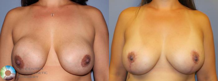 Before & After Breast Implant Revision Case 11370 Front View in Golden, CO