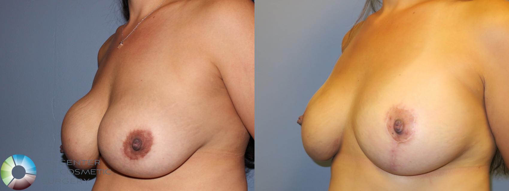 Before & After Breast Implant Revision Case 11370 Left Oblique View in Golden, CO