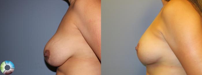 Before & After Breast Implant Revision Case 11370 Left Side View in Golden, CO