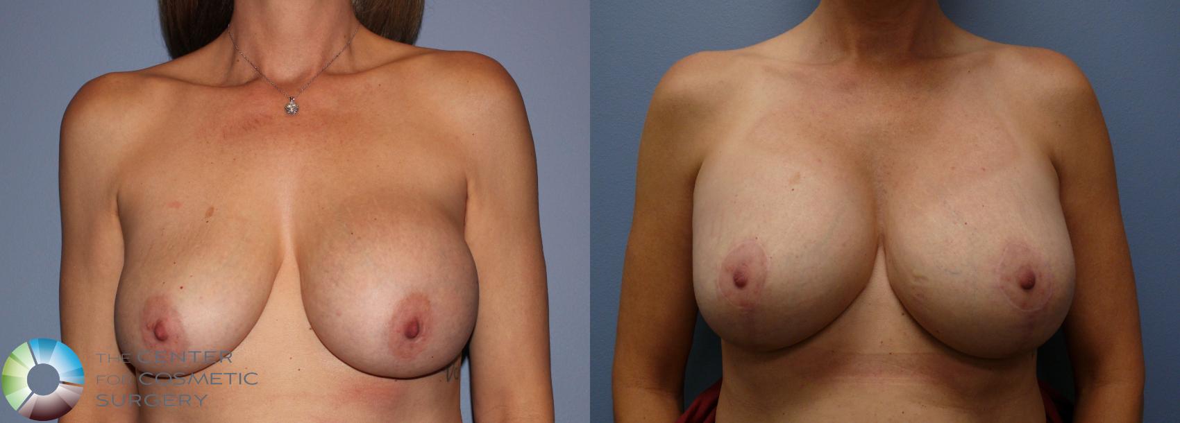 Before & After Breast Implant Revision Case 11372 Front in Denver, CO