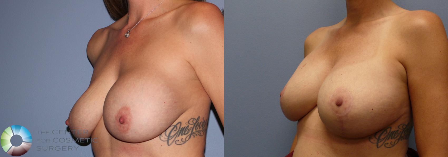 Before & After Breast Implant Revision Case 11372 Left Oblique in Denver and Colorado Springs, CO