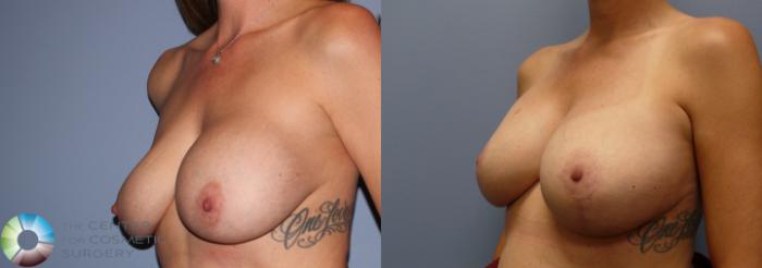Before & After Breast Implant Revision Case 11372 Left Oblique in Denver, CO