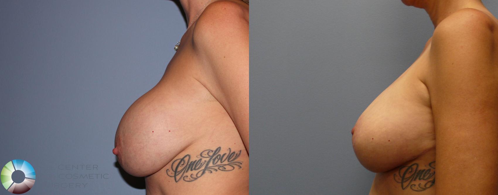 Before & After Breast Implant Revision Case 11372 Left Side in Denver and Colorado Springs, CO