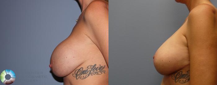 Before & After Breast Implant Revision Case 11372 Left Side in Denver, CO