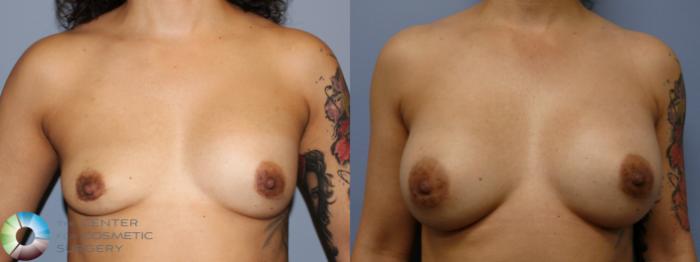 Before & After Breast Implant Revision Case 11373 Front View in Golden, CO