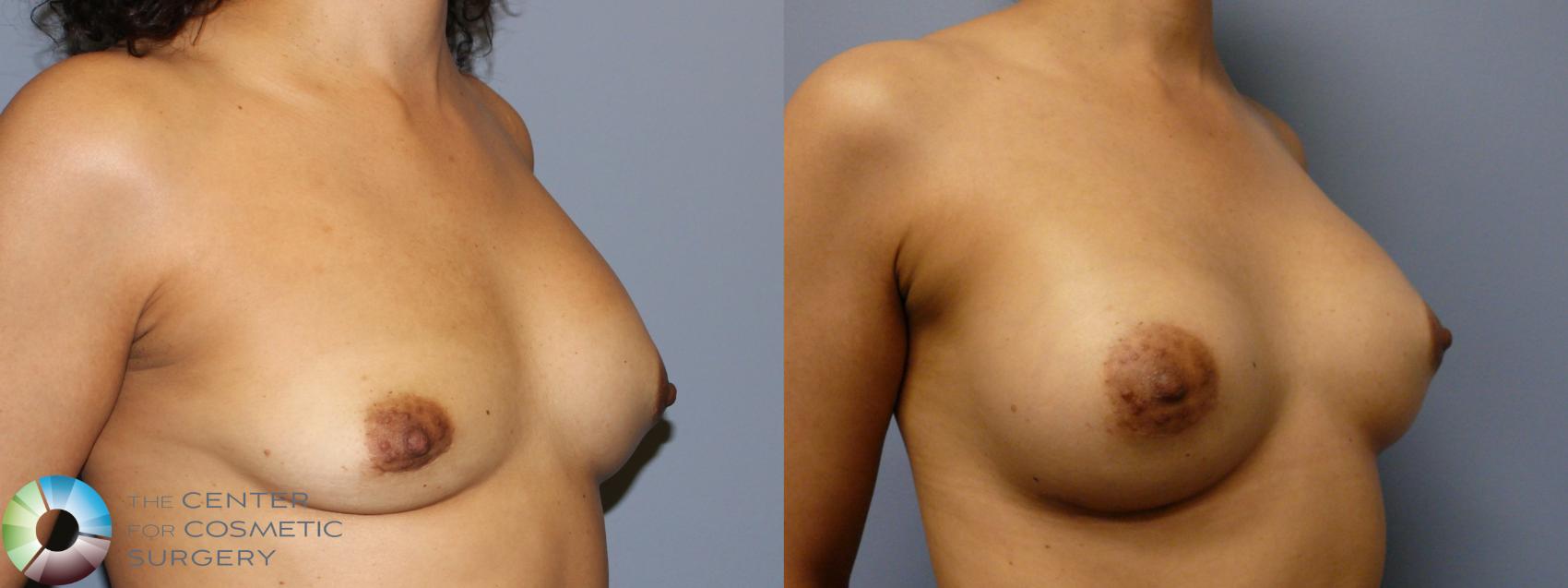 Before & After Breast Implant Revision Case 11373 Right Oblique in Denver and Colorado Springs, CO